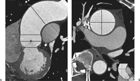 Thoracic Aorta Radiology Key