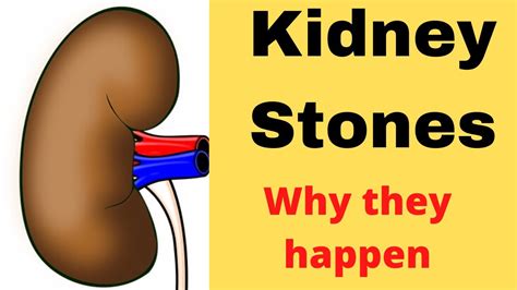 What Causes Kidney Stones How Kidney Stones Happen Youtube