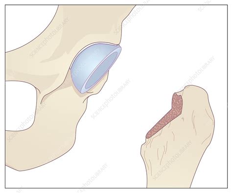 Hip Replacement Artwork Stock Image C008 5308 Science Photo Library