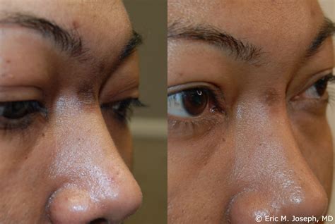 Eric M Joseph Md Acne Scar Correction Before And After Improved
