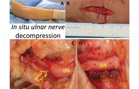 Peripheral Nerve Entrapment And Their Surgical Treatment Intechopen