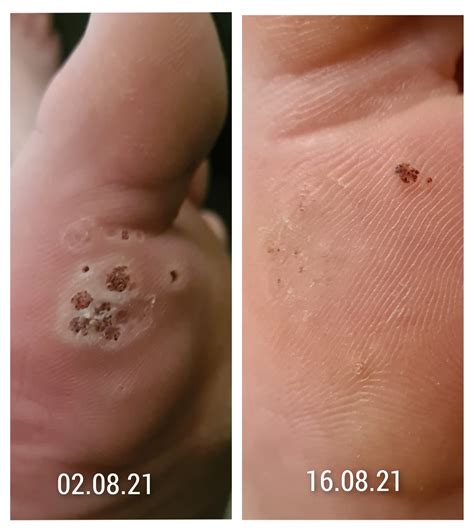 Case Study Successfully Treating A Foot Covered In Plantar Warts