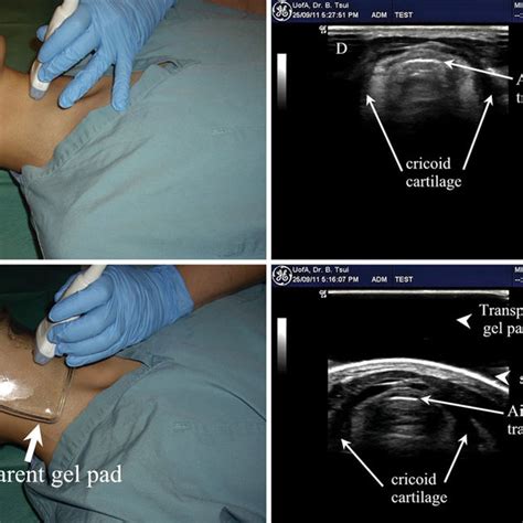 Figure Ultrasound Images Of Airway With And Without Gel Pad Top