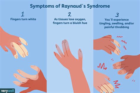 What Is Raynauds Syndrome 2022