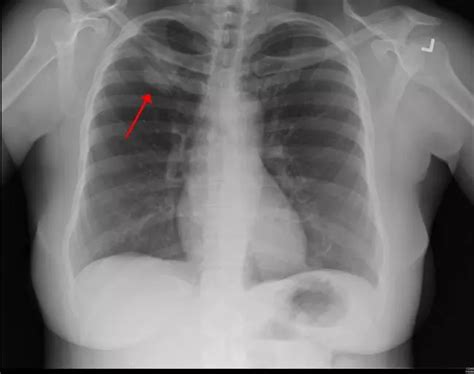 Lung Cancer X Ray Photos — Examples Of Different Types Of Results