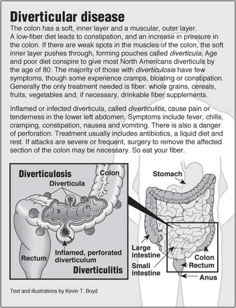 Information Graphic About Diverticulosis And Diverticulitis With Links