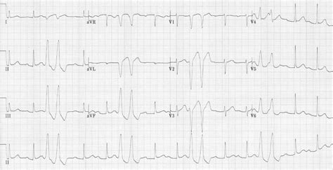 Premature Ventricular Contractions Couplet