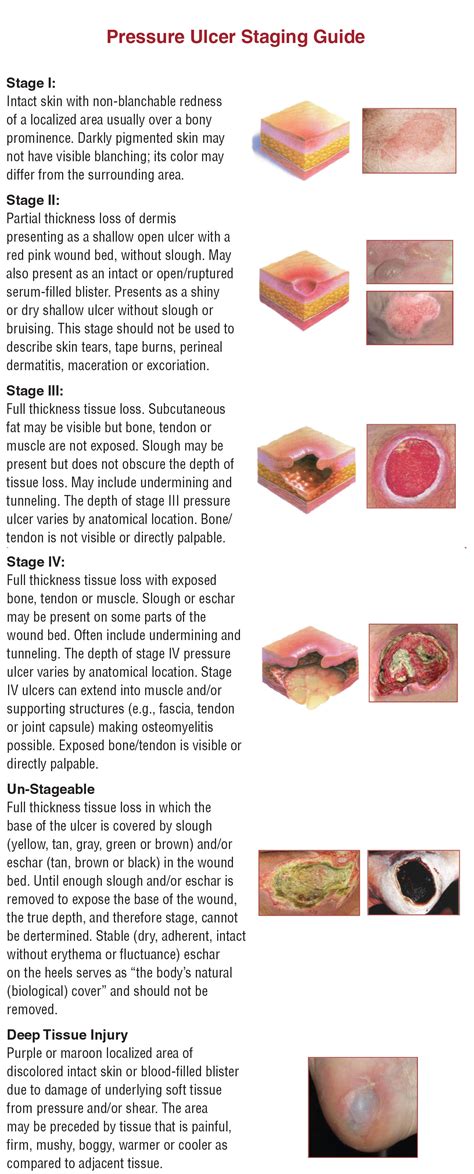 Pressure Ulcer Staging Chart Pressure Ulcer Staging Wound Care My Xxx