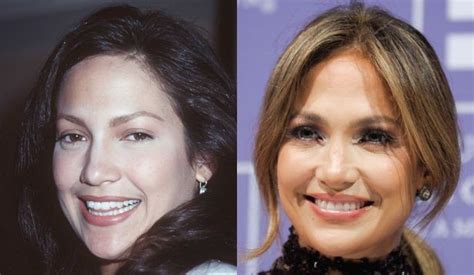 Jennifer Lopez Before And After Plastic Surgery 01 Celebrity Plastic