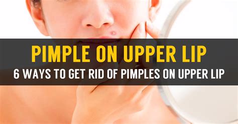 21 yrs old male asked about swollen upper lip with pus pimple, 6 doctors answered this and 4595 people found it useful. Learn How To Treat Pimple On Upper Lip & Causes