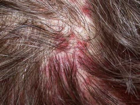 Causes And Treatments Of Your Itchy Scalp And Hair Loss