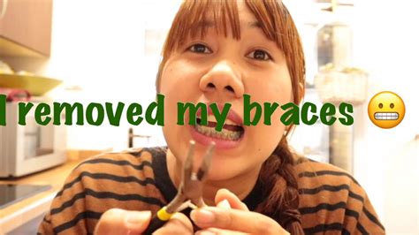 How To Remove Braces At Home Youtube