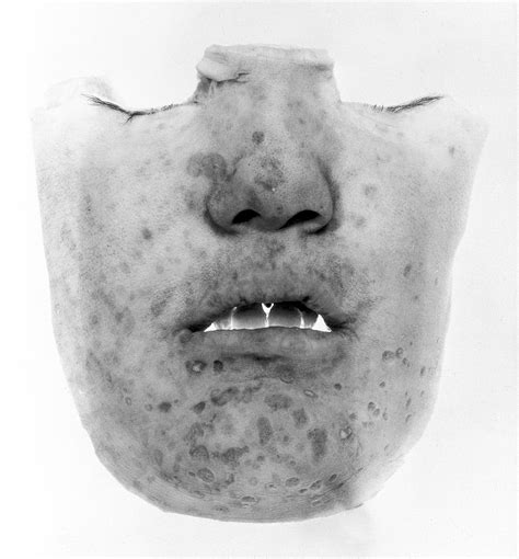 Photograph Facial Scars Of Smallpox Wellcome Collection