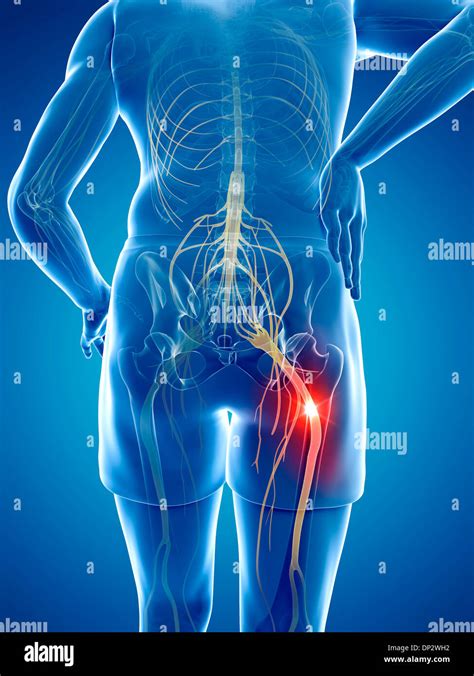 Sciatic Nerve Pain Hi Res Stock Photography And Images Alamy
