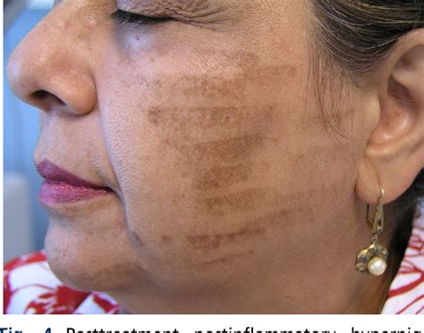 Figure 4 From Laser Skin Treatment In Non Caucasian Patients