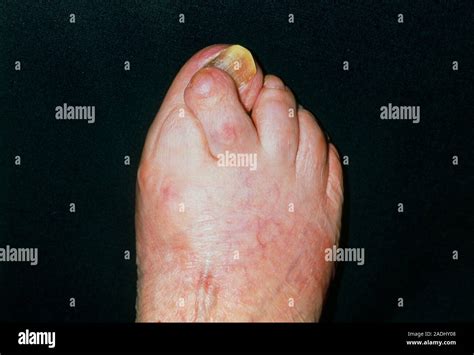 Hallux Valgus Inward Turning Big Toe And Overriding Second Toe On The