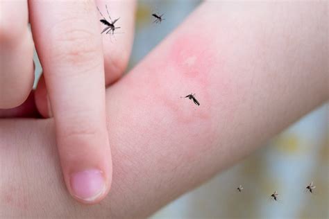 Dengue Mosquito Bite Mark