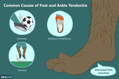 Tendonitis Of The Foot And Ankle