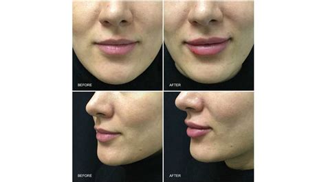 Before And After Juvederm Ultra Lipstick Review