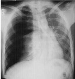 Lvlupfit.comwhat organ in just underbthe bottom. Needle a Tension Pneumothorax