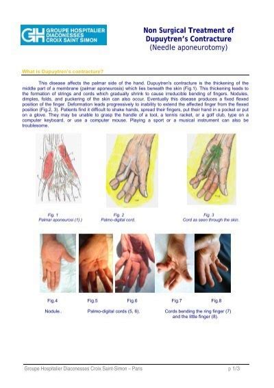 Non Surgical Treatment Of Dupuytrens Contracture Needle