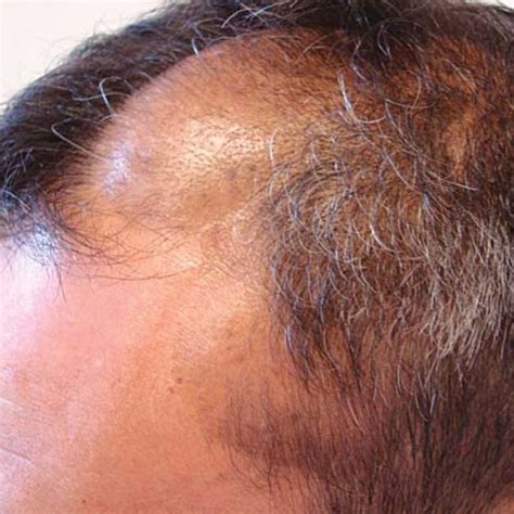 Pdf Diffuse Neurofibroma An Uncommon Cause Of Alopecia