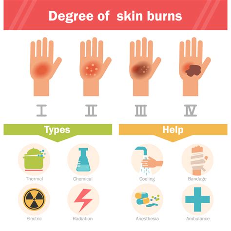 First Degree Burn Pictures First Degree Burns Vs Second Degree Burns