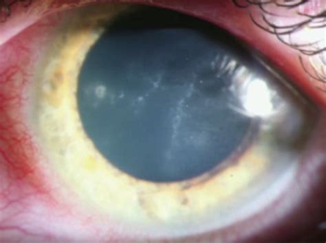 Acanthamoeba Keratitis