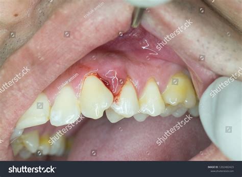 Gingival Abscess From Periodontal Problem Royalty Free Stock Photo