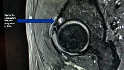 Hip Cysts Acetabular Paralabral Cyst And Subchondral Cyst Fai