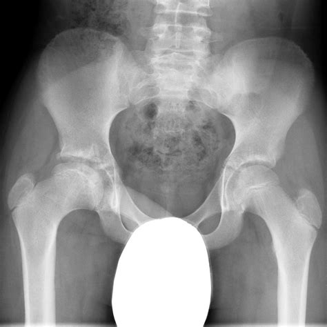 Perthes Disease Radiology Case Disease Radiology