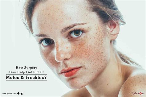 How Surgery Can Help Get Rid Of Moles And Freckles By Dr Prachi Patil Lybrate