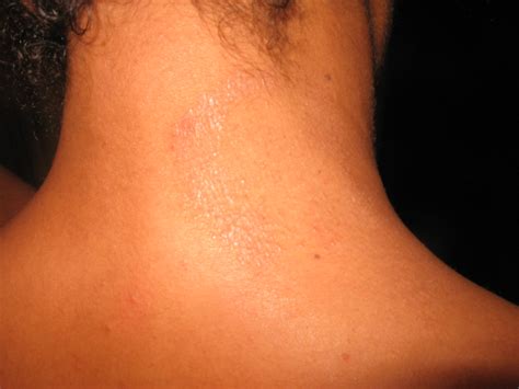 Img3961 Rs Eczema Dry Spot Rash On Back Of Neck At Home Flickr