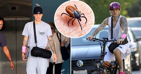 Justin Bieber Spent Most Of Battling Lyme Disease