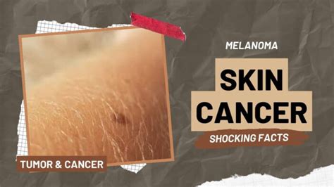 4 Shocking Facts About Skin Cancer Melanoma That Everyone Should Know