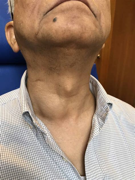 Dr Dennis Chuas Complete Guide To Neck Lump Issues In Singapore