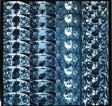 Magnetic Resonance Imaging Mri Of Female Hip Joint Stock Photo Image