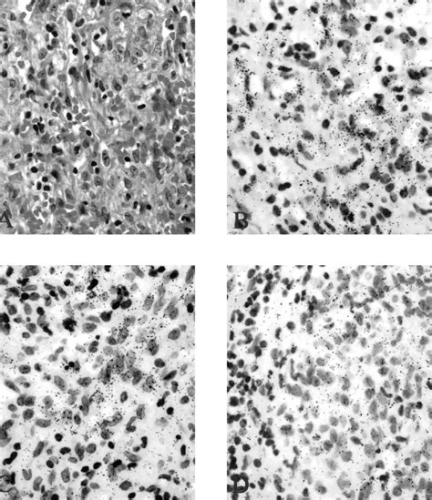 Infectious Angiogenesis Bartonella Bacilliformis Infection Results In