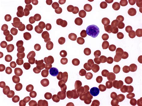 Patients With Polycythemia Vera Mostly Remain In Target Hematocrit