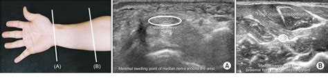 Figure 1 From Carpal Tunnel Syndrome Assessment With Ultrasonography A