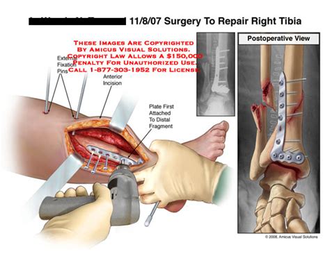 Amicus Illustration Of Amicus Surgery Leg Repair Open Incision Plate Screws Orif Fixation Tibia