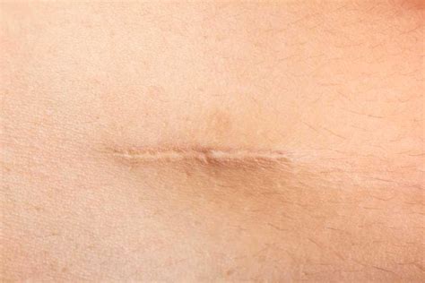 A Guide To Scars Types And Treatment Options The Dermatology Review