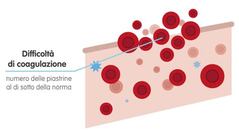 Una diminuzione delle piastrine circolanti nel sangue può essere causata. Anemie e Piastrinopenie - Le malattie del sangue ...