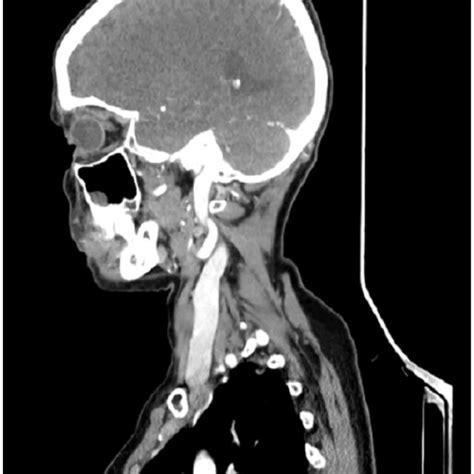 Contrast Enhanced Axial Ct Image Showing Dilated Right Internal Jugular