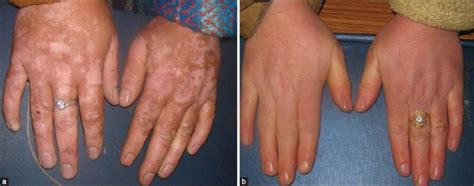 A Residual Pigmentation On Hands And B After 2 Sessions Of