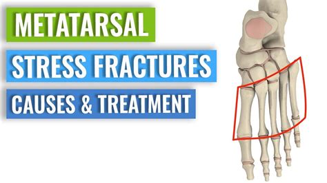 Metatarsal Stress Fractures Causes Treatment Prevention Youtube