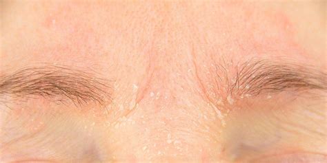 Eyebrow Dandruff Is A Thing—heres How To Treat It Eyebrow Dandruff