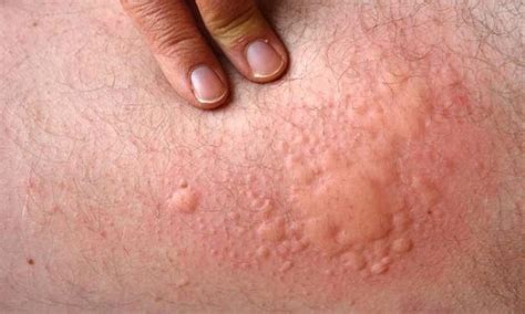 Hives Causes Symptoms And Treatment Health Care Qsota Tips And