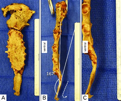 Variant Of The Xiphoid Process A An Anterior View Of The Ster Num