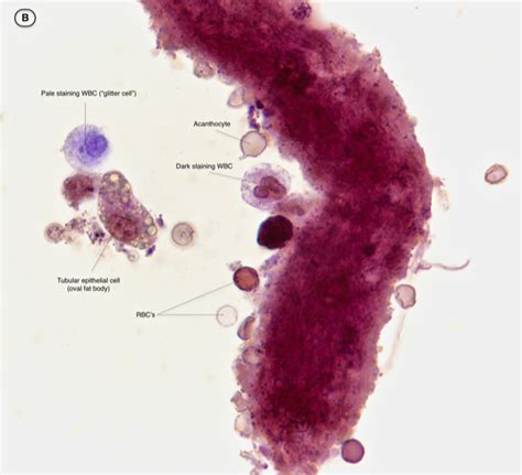 Urine Sediment Of The Month White Blood Cells Glitter Cells And